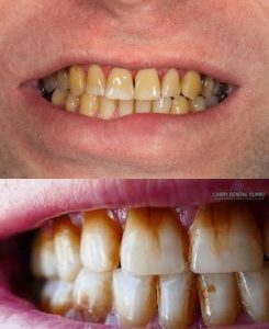 Reasons Why Teeth Stains And How To Go About It Easily